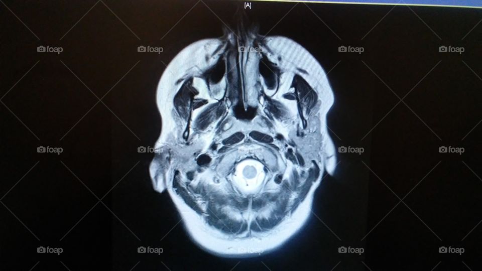 MRI - Brain Scan