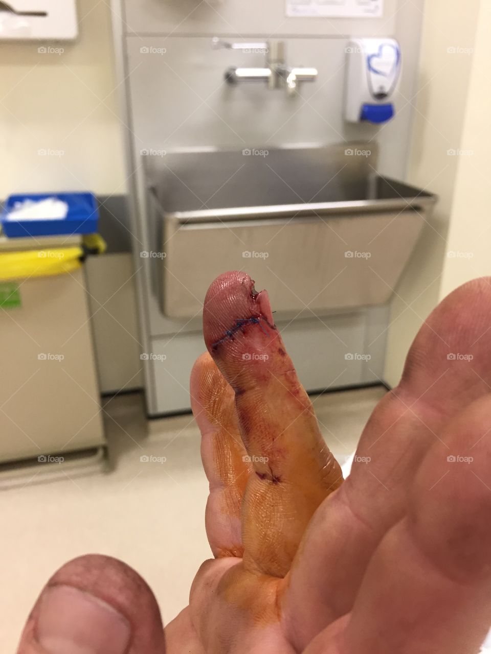 When I amputated the tip of my finger. 