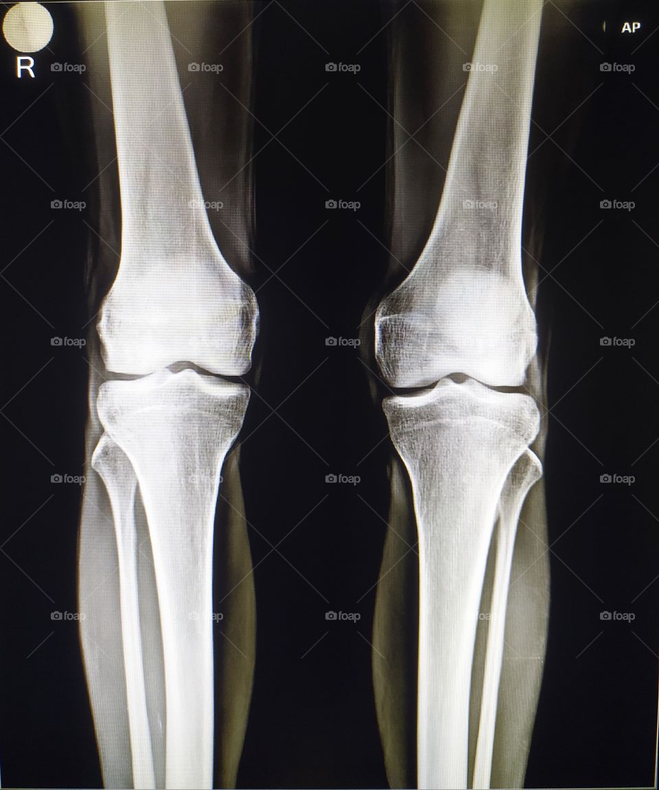 Knee Ap xray view of both knee