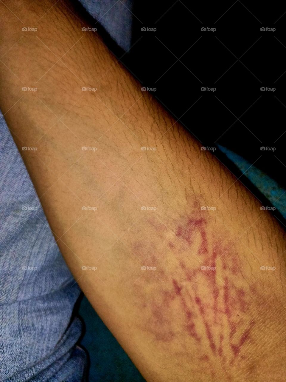 Red scar on arm. Scars that appear after blood donation. Red and painful bruise and scratching on human skin