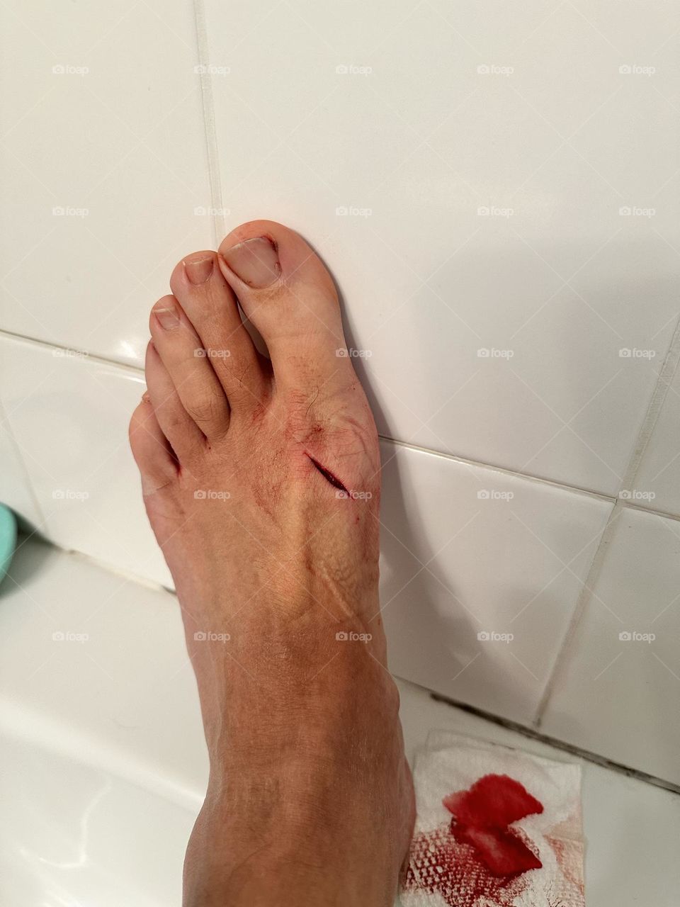 Knife wound in foot, chef drops knife on foot, cut on foot, foot injury while cooking 