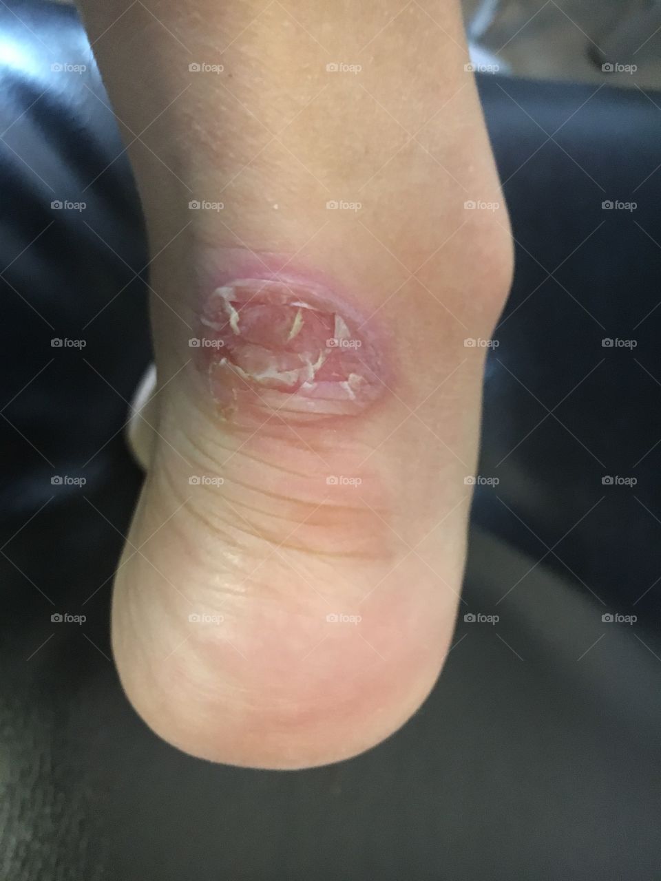 Heel wound after a salt bath 