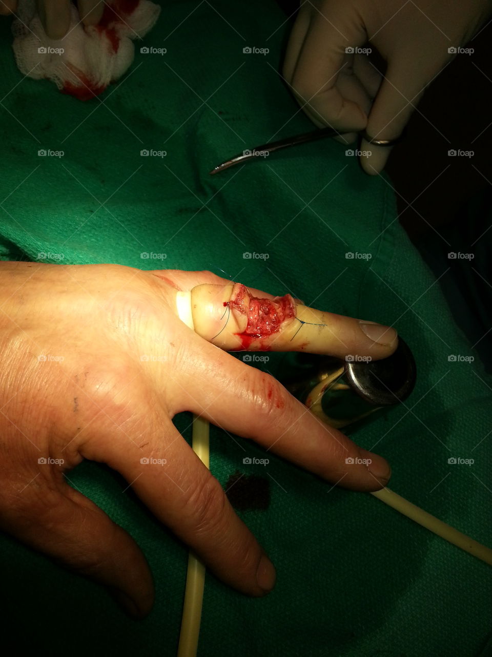 finger ligament operation