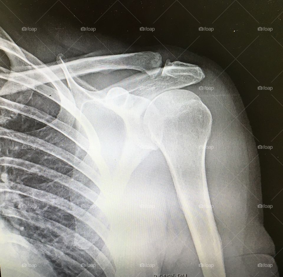 Shoulder xray