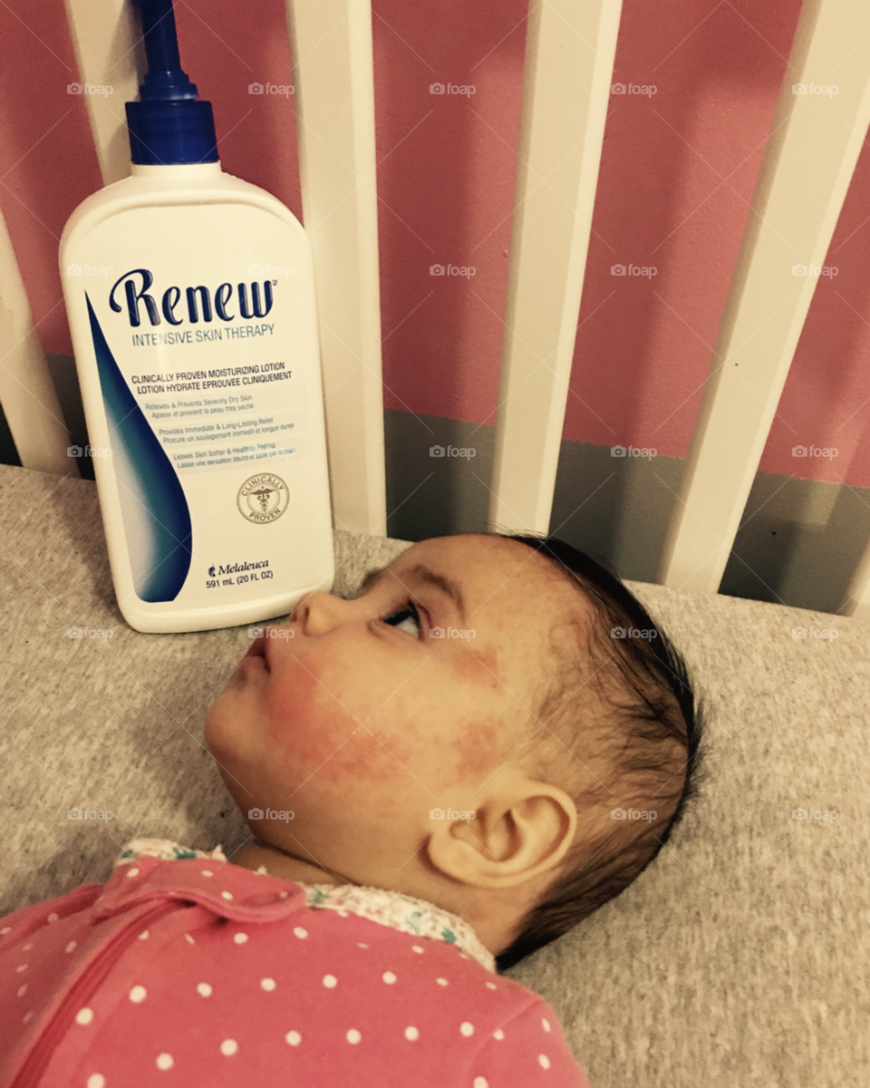 Melaleuca Renew Cream with baby with eczema