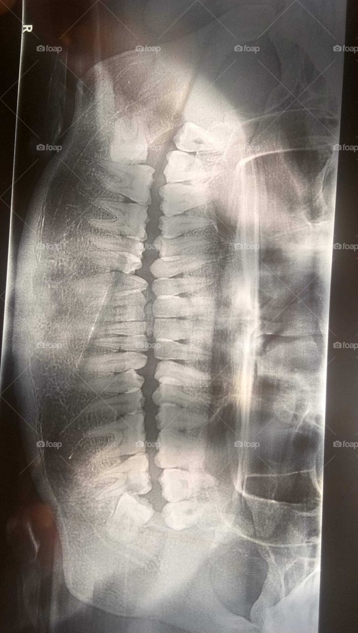 teeth with X-rays