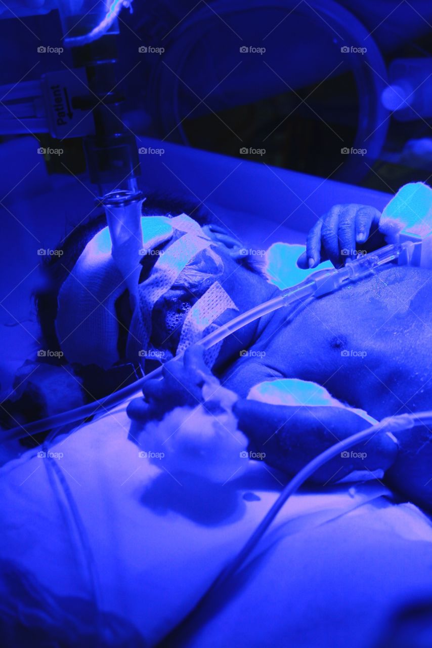 50/50. A respiratory distesss prematurity newborn in the incubator with respirator and phototherapy