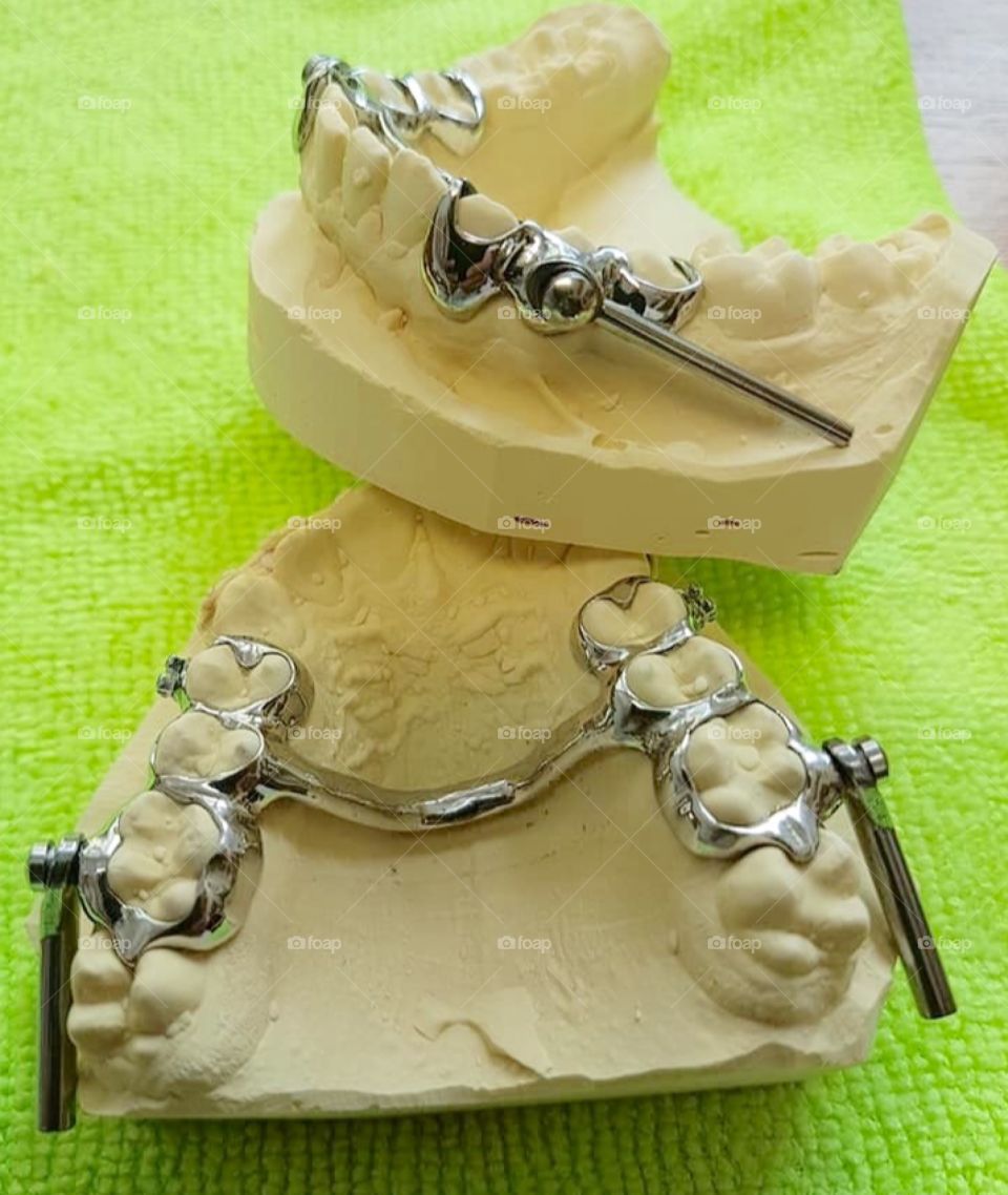Dental Brases, prosthesis, metal prosthesis 