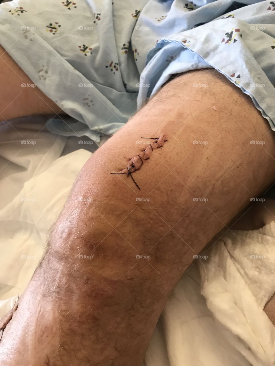 Stitches above the knee