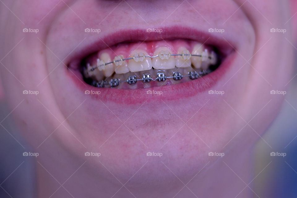 braces
