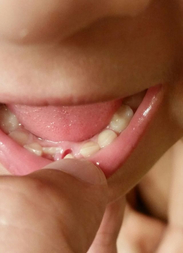 Exchanging from loose milk teeth to adult teeth . child changing teeth growing up