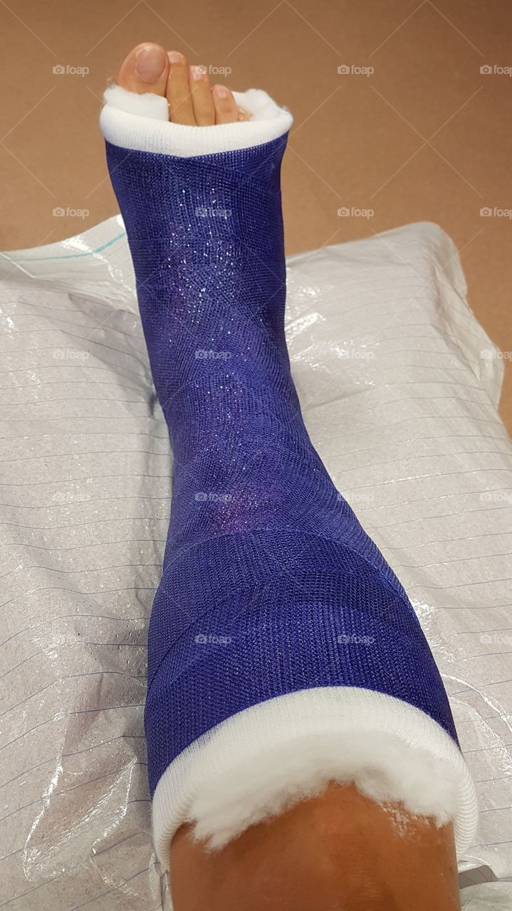 Blue short leg cast with glitter, foot surgery - blått gips med glitter, fotoperation underben 