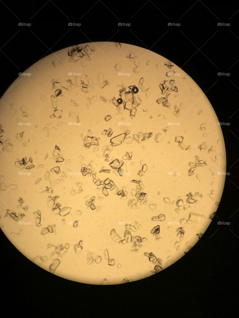 Urine Sediment with crystals 