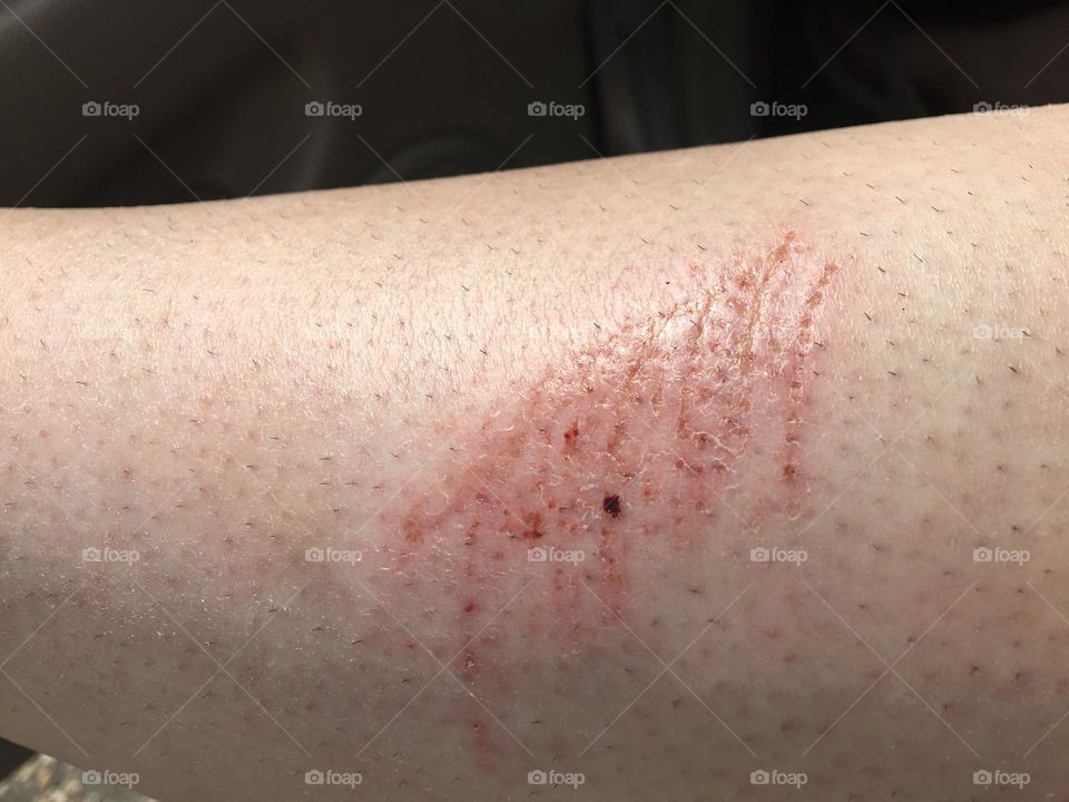 Bare white lady’s leg showing her injury of a scrap on her calf