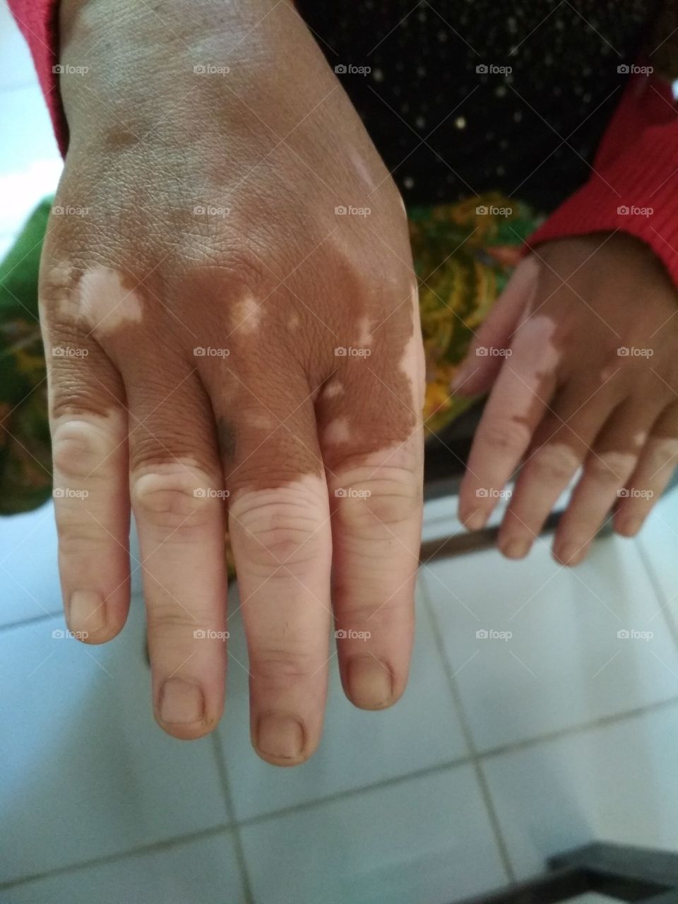The sick hand