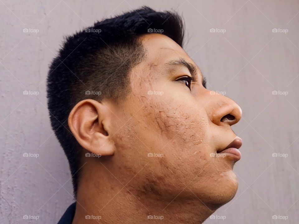 dark-skinned man seen in profile, with acne scars