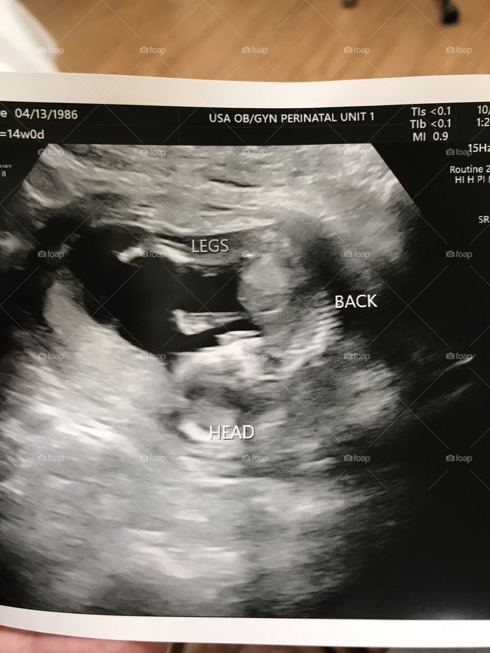 14 week ultrasound of a fetus