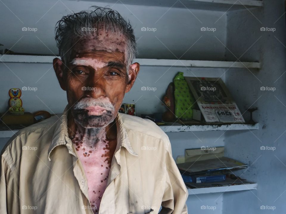 Man's hand with vitiligo