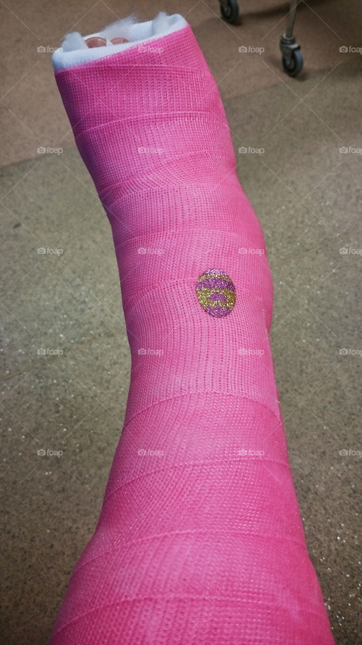 Pink short leg cast after foot surgery  - Rosa gips på underben efter fotoperation