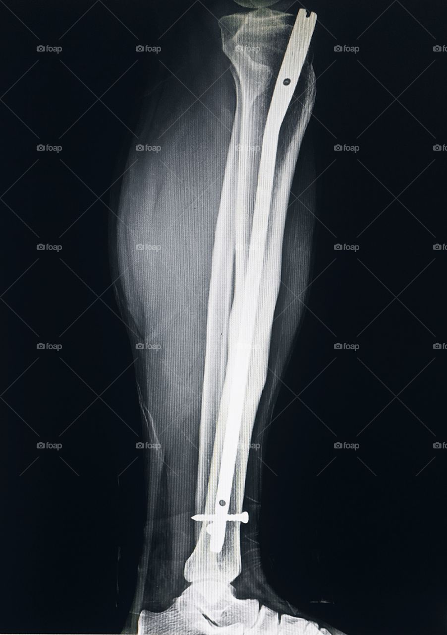 Nail Insertion Post operative Tibia Lateral Xray view