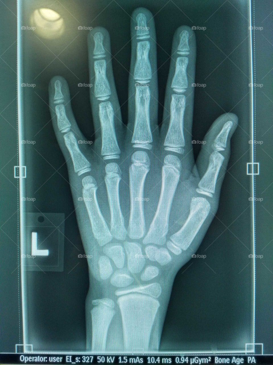X-ray left hand