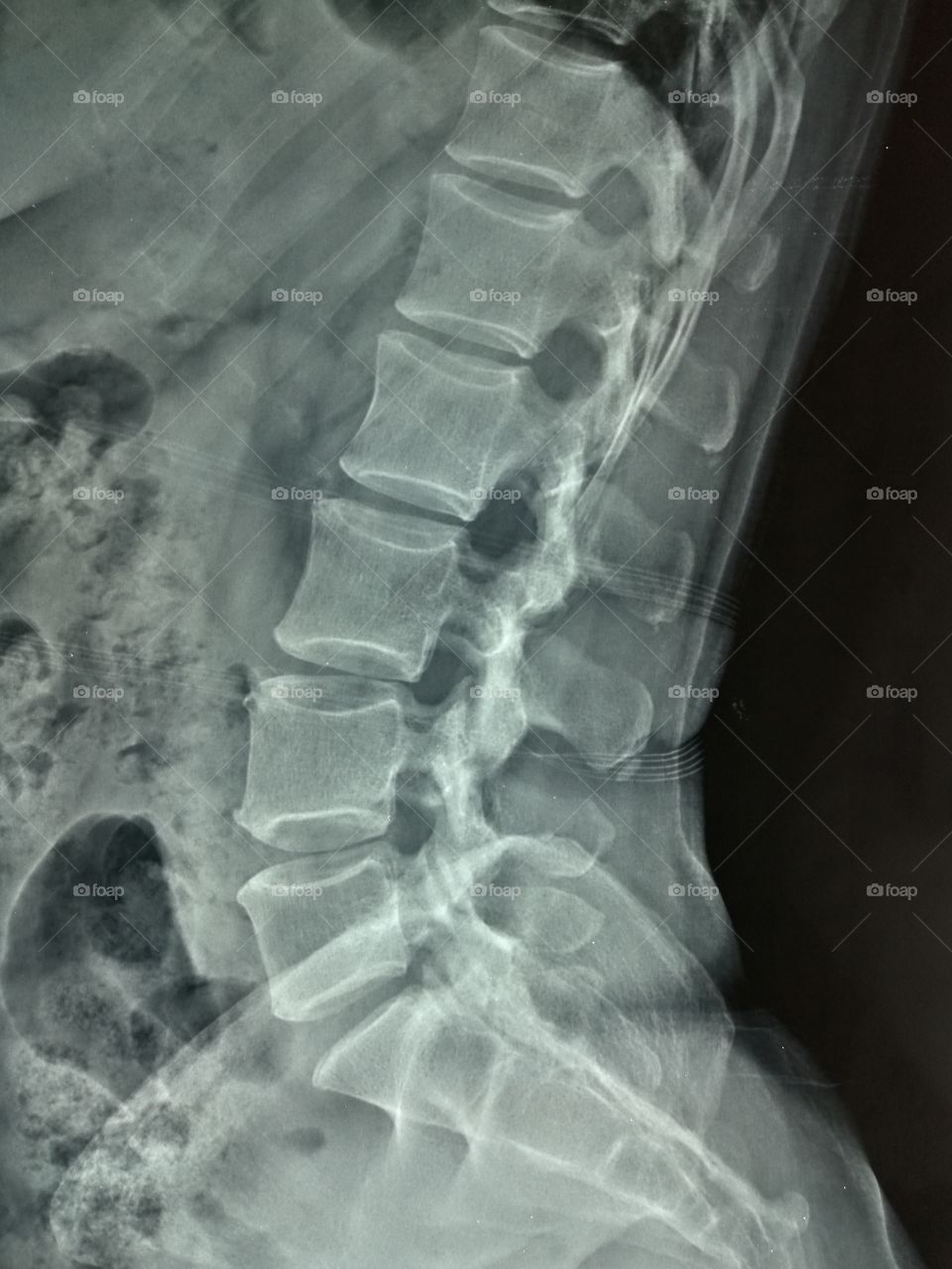 spine radiology x ray
