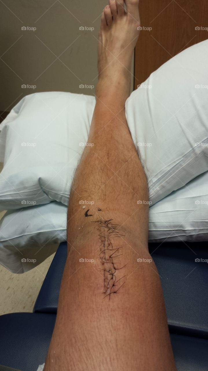 knee stitches. recovering from patellar tendon repair surgery
