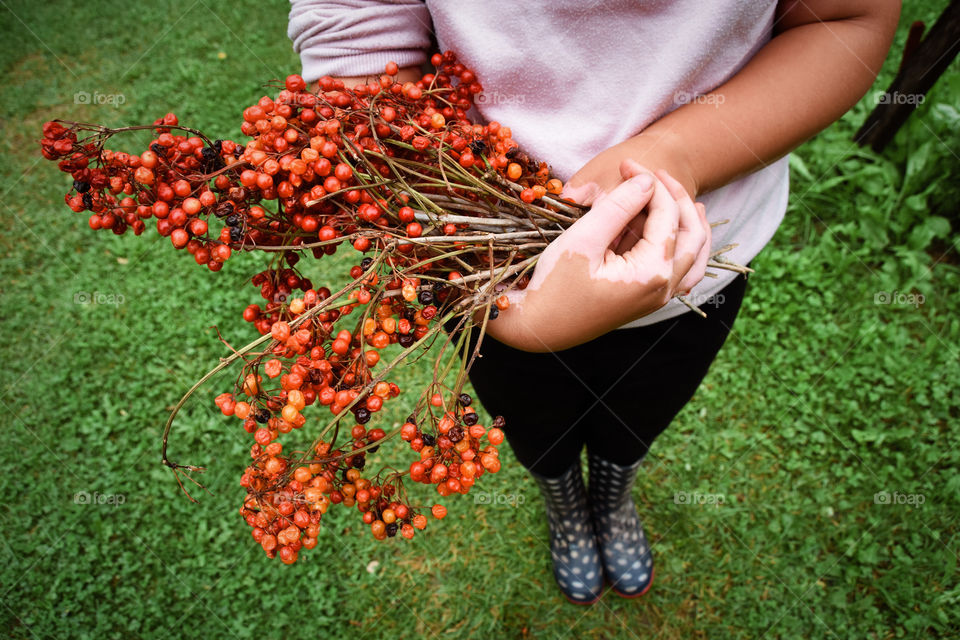 Viburnum berries in hands of a girl with vitiligo skin disorder 