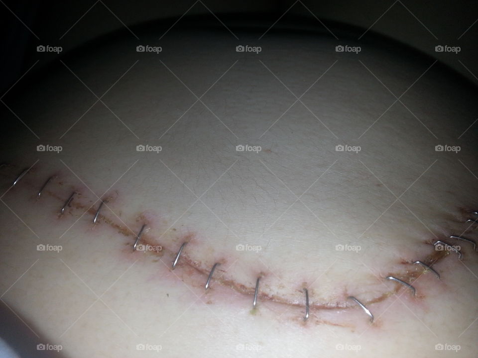 Surgery scar