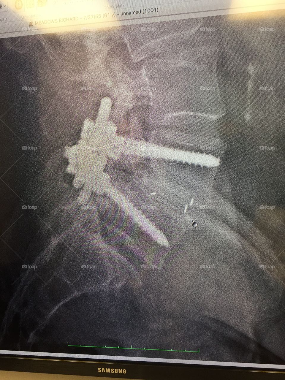 Lumbar Spine Fusion 