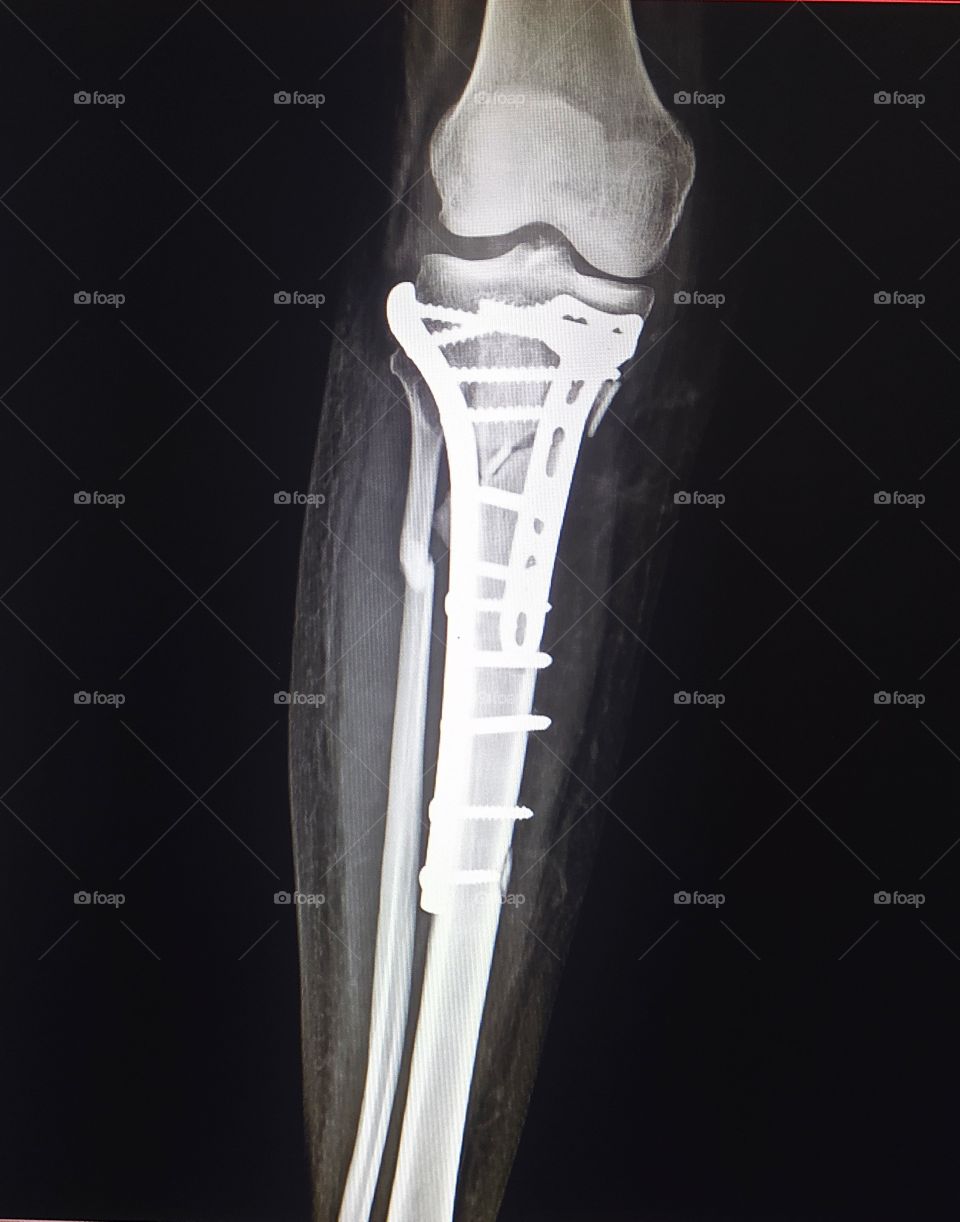 Tibial Plateau Fractur Post Operative Xray Image