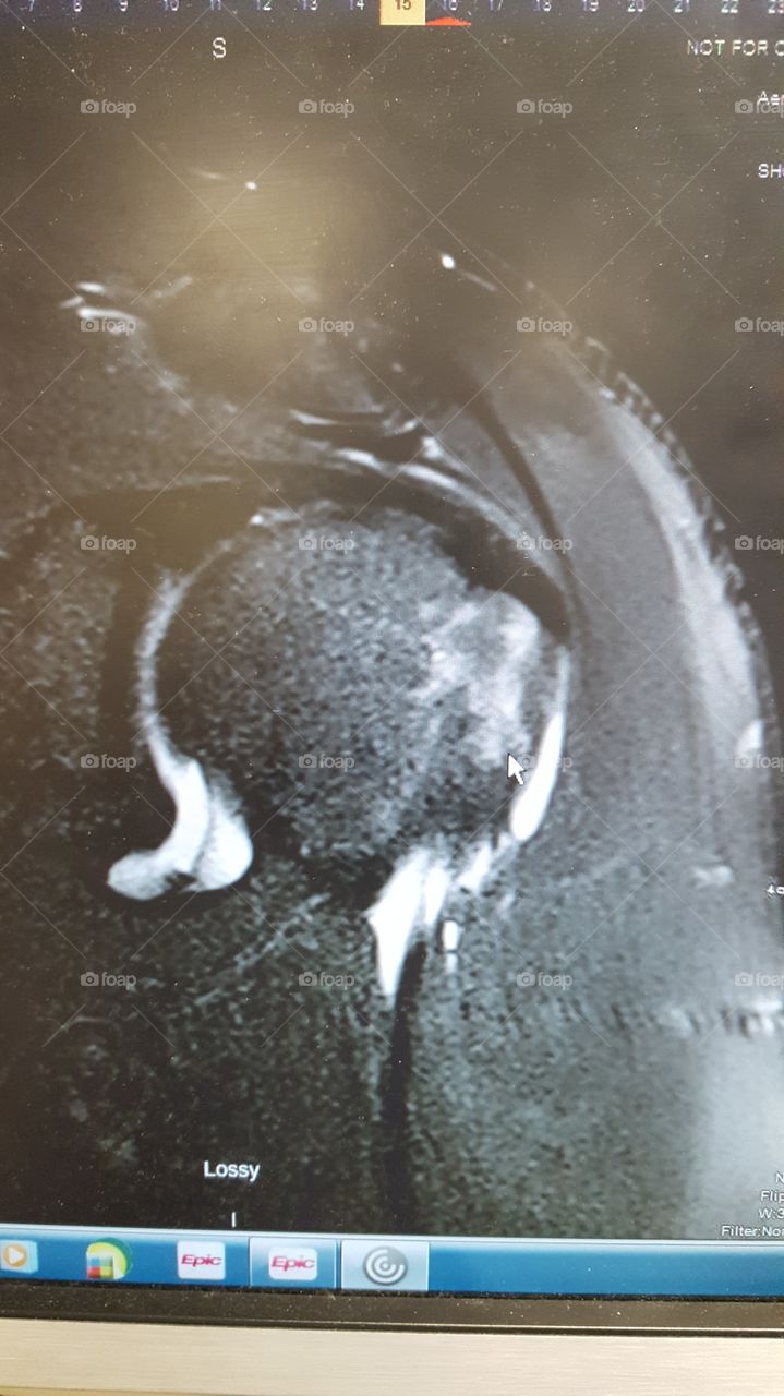 shoulder MRI