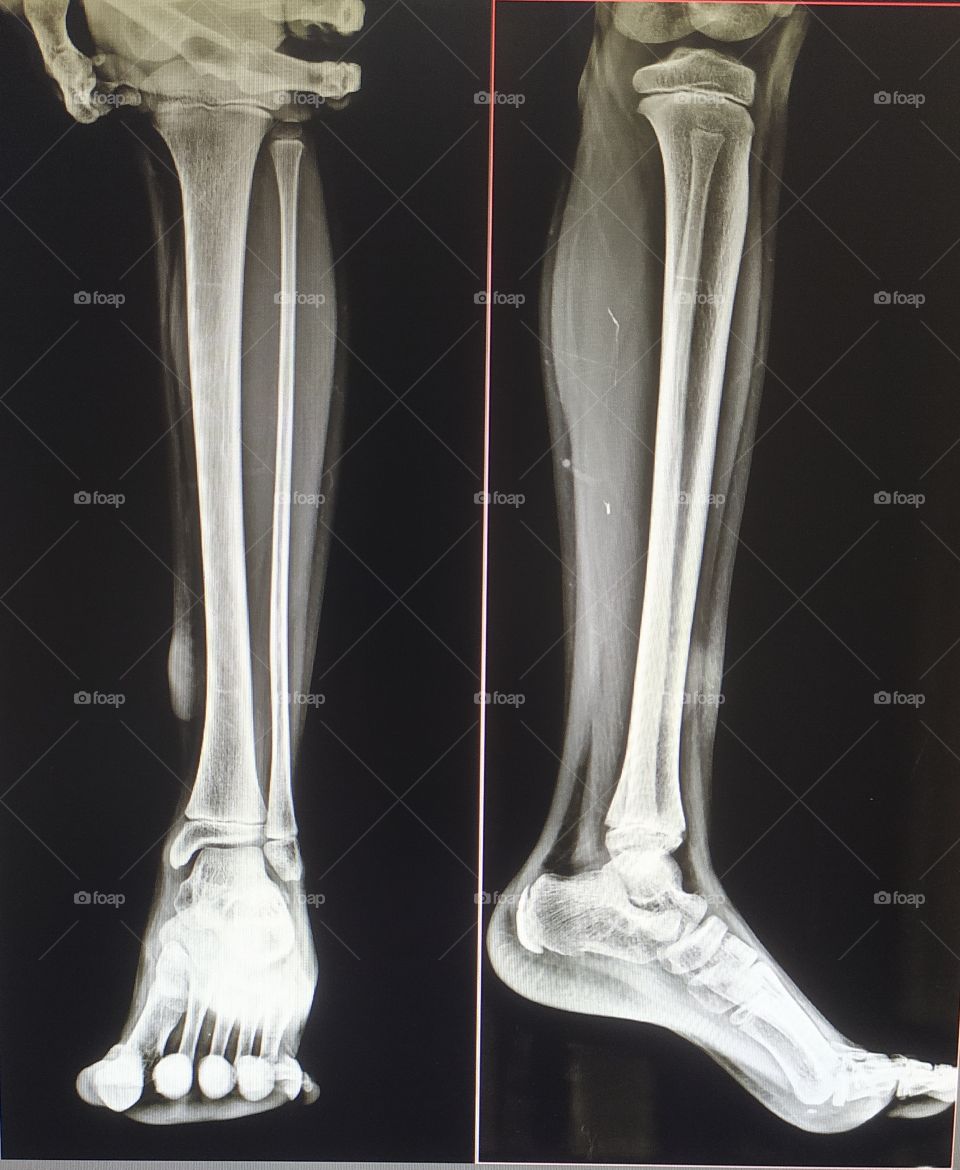Xray view of Lower leg Ap/lateral