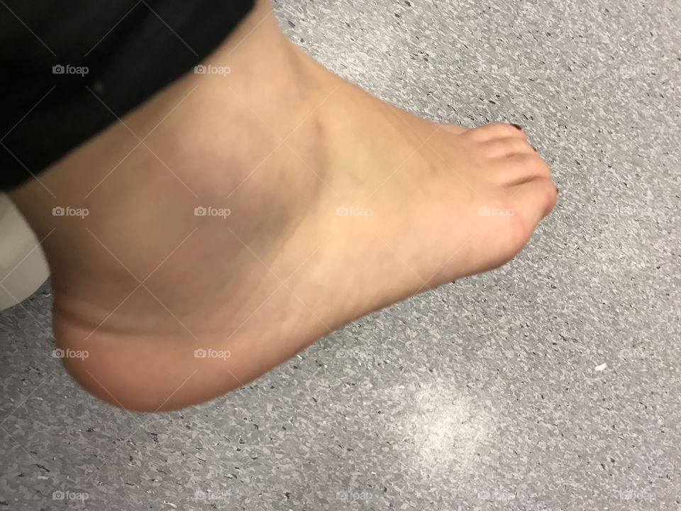 Swollen foot