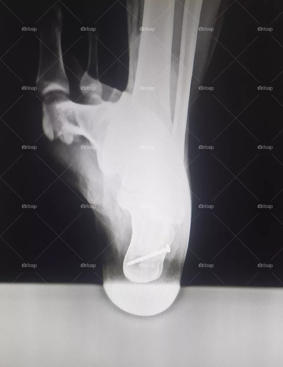 Xray of Lower Heel Shows Iron Nails is inserted inside lower Heel accidentally in industrial field