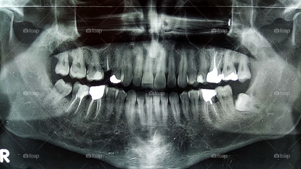 Close-up of a panoramic dental x-ray