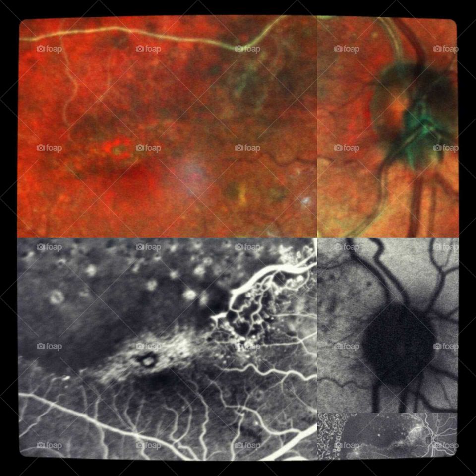 Retina/fundus photograph with diagnostic test  Fluorescein Angiogram.