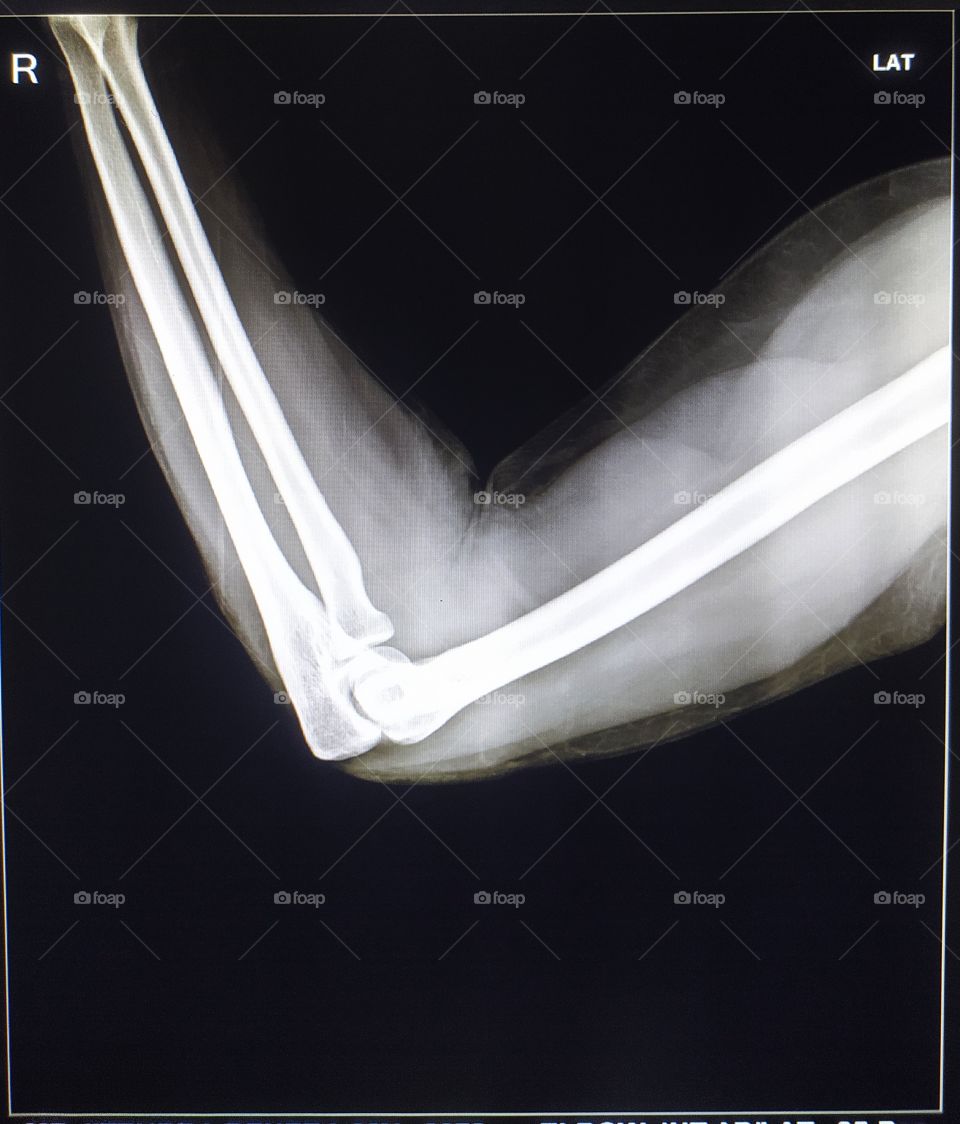 digital Xray of Elbow lateral view