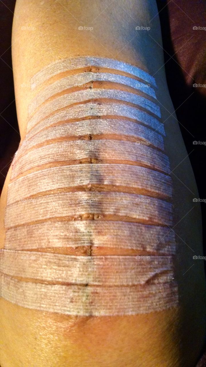 Total Knee Replacement