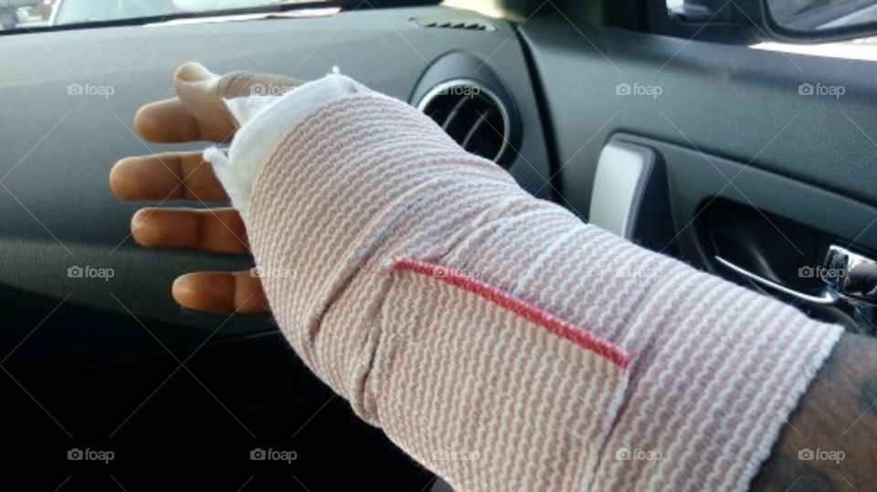 My hand wrapped with some thick gauze, after having Carpel Tunnel Release surgery, in Orlando, Florida