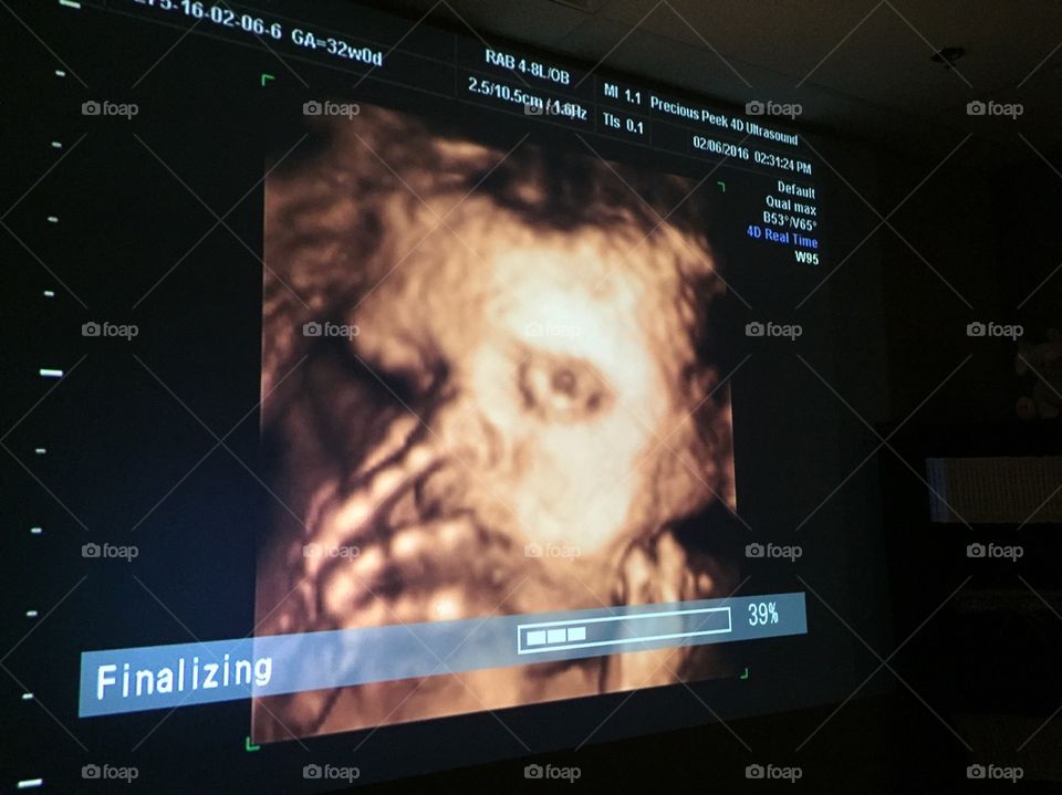 3D Ultrasound of baby boy