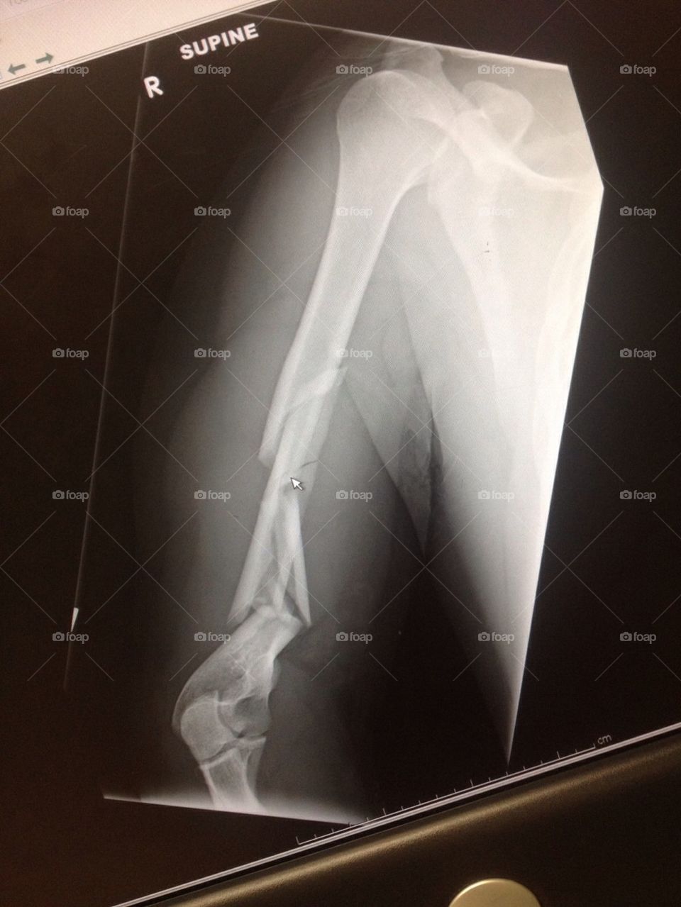 Codys broken arm