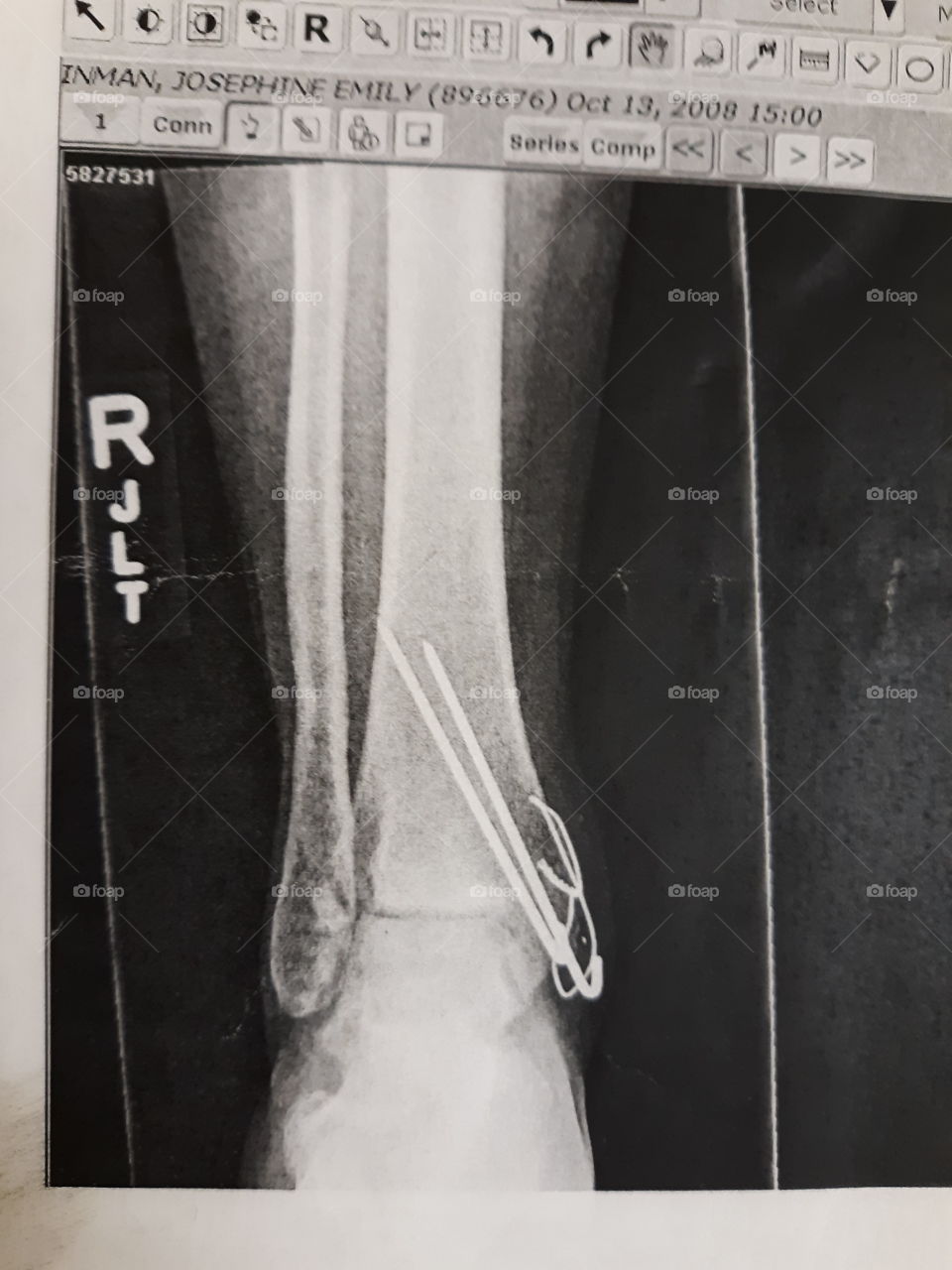 2 of 2 - Front view of ankle after bone graph