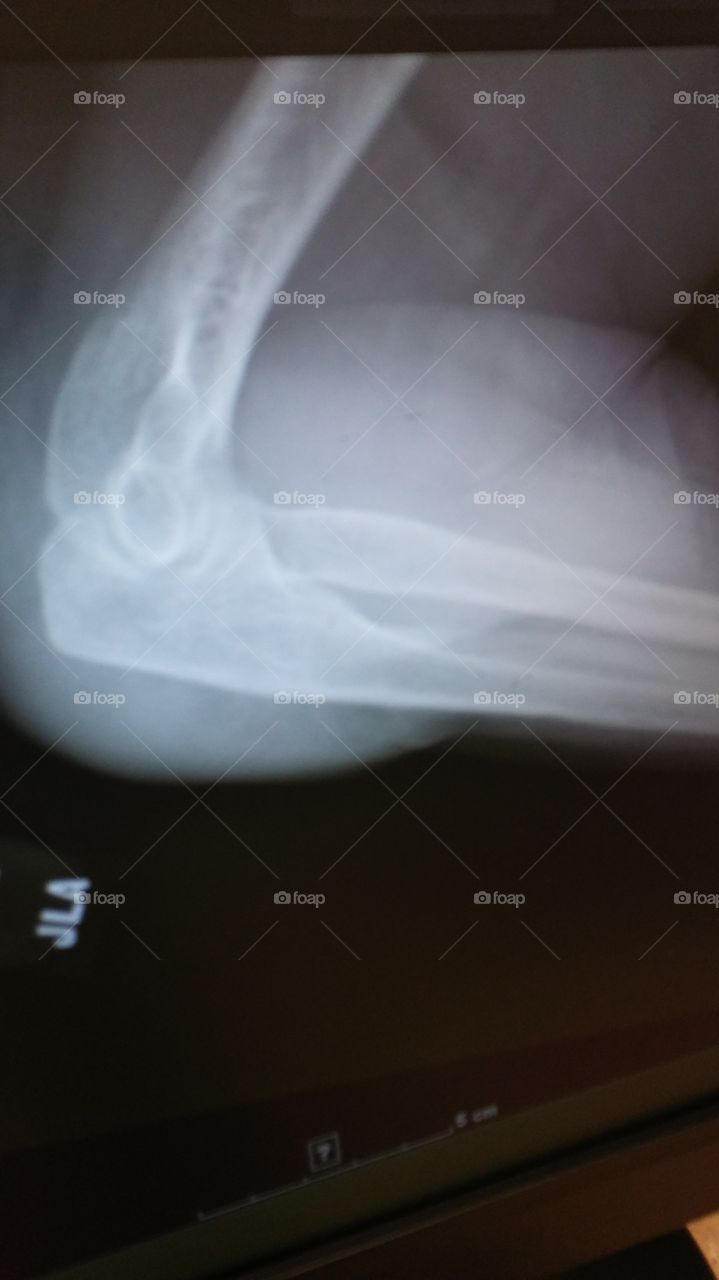 Elbow X-ray