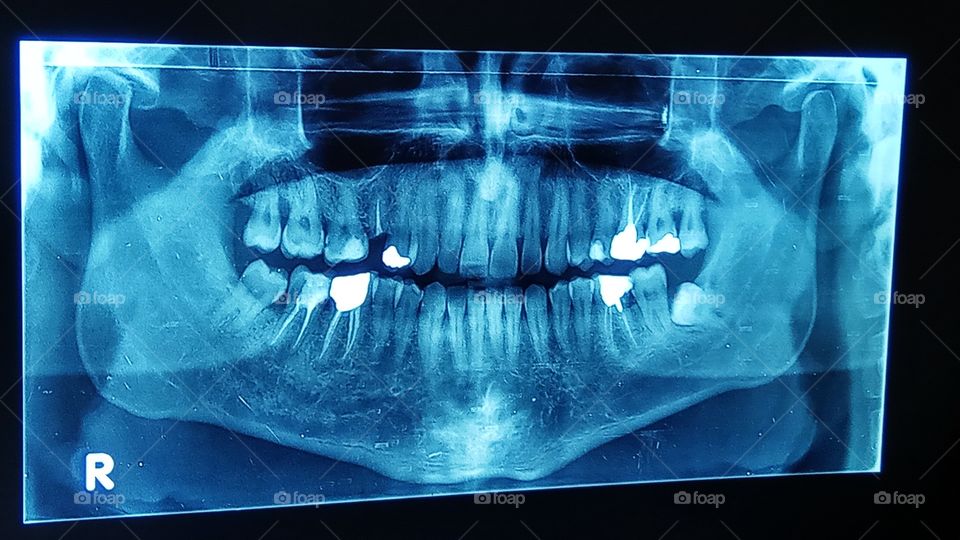 Panoramic dental x-ray,the bottom right wisdom tooth seems to be impacted