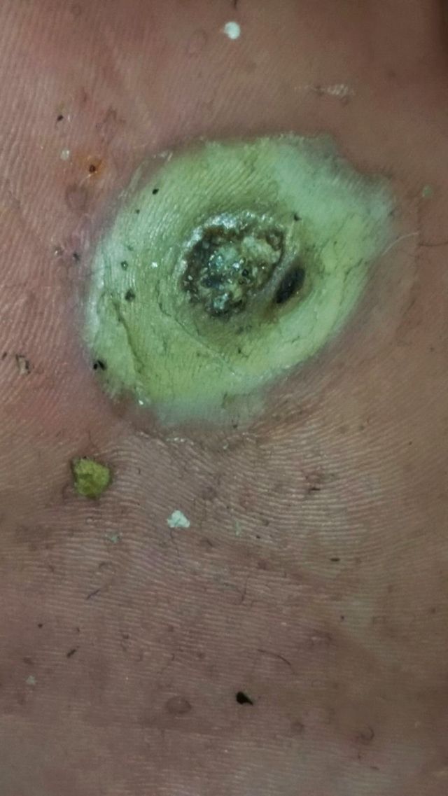 Wart