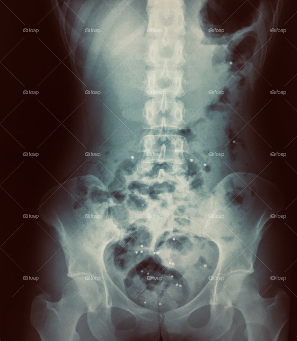 X-ray of a Female Torso with Digestive Markers 