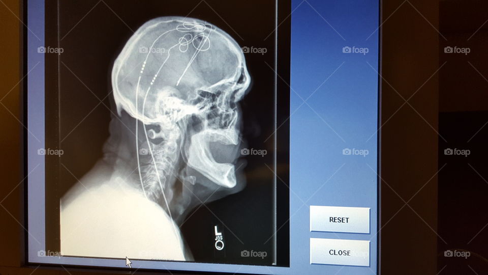 dbs lead check lateral skull