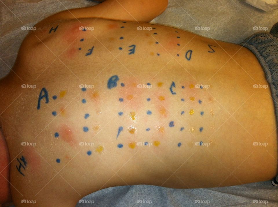 Allergy testing