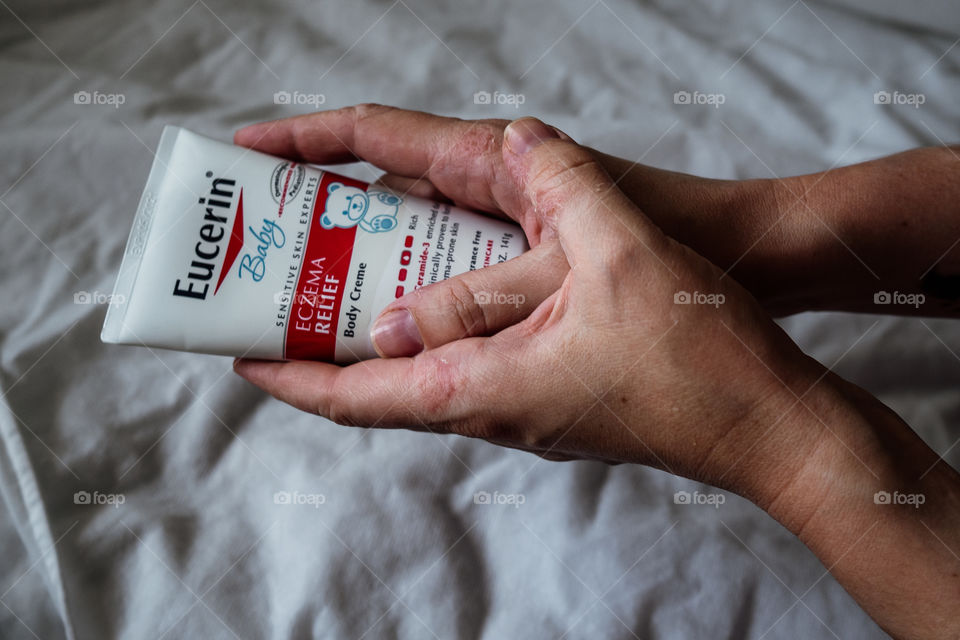 Women's hands with irritation on the skin hold cream
